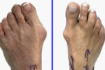 Bunions