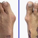 Bunions