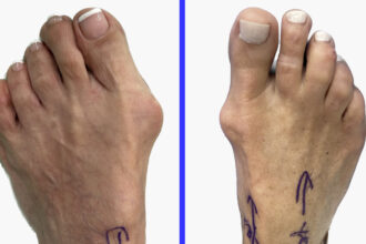 Bunions