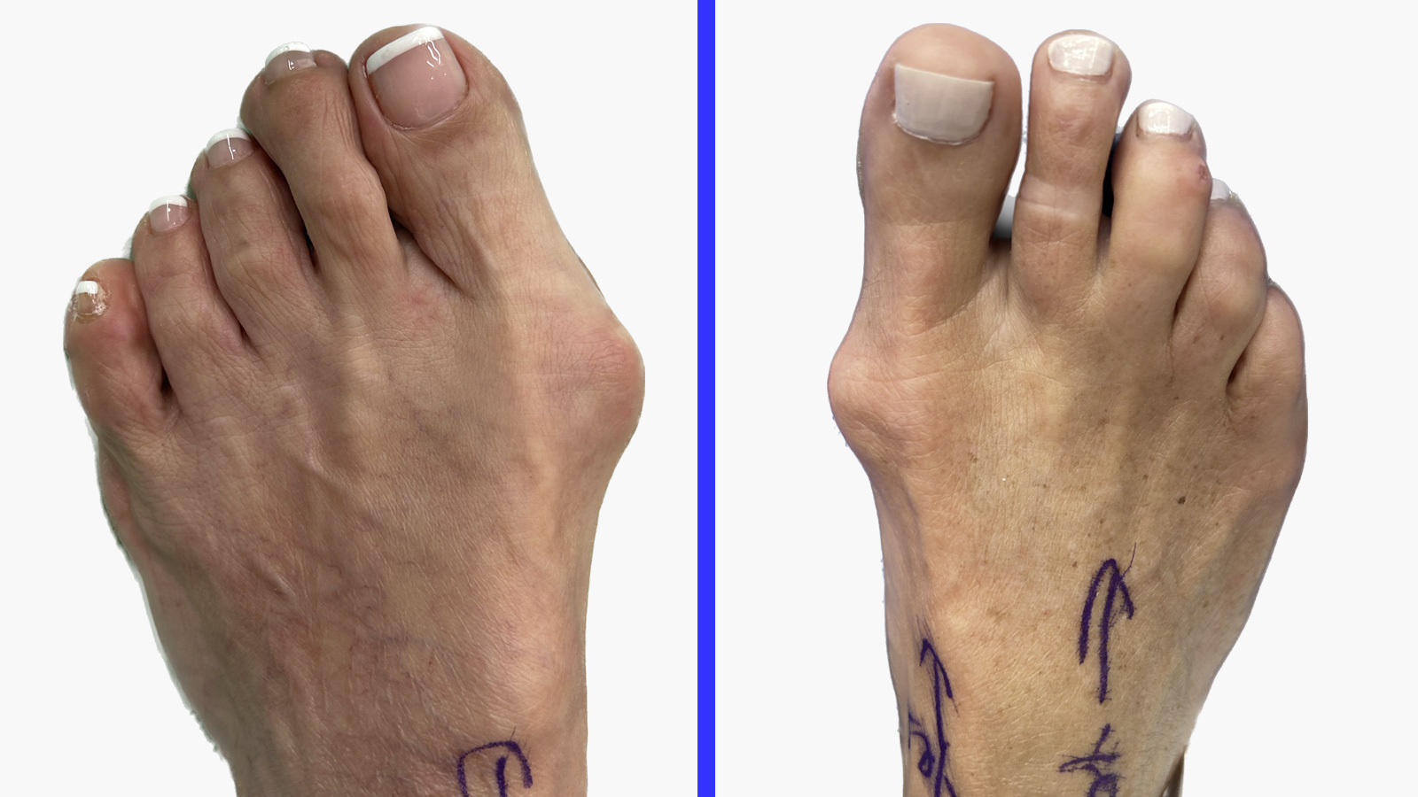 Bunions